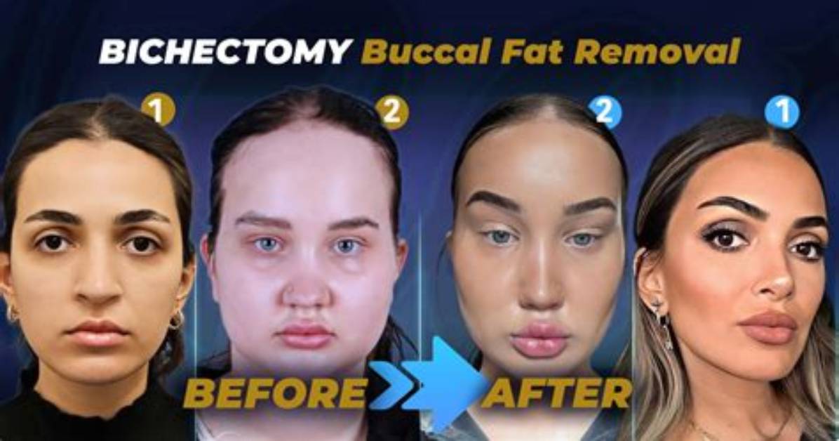 A Deeper Dive into Buccal Fat Removal