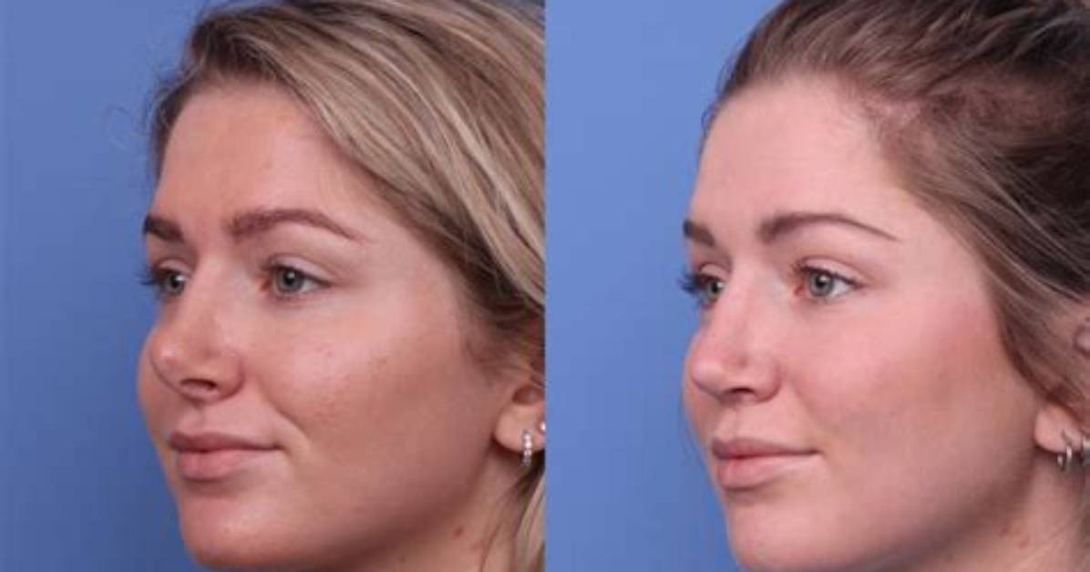 Before and After Photos and Surgery Details