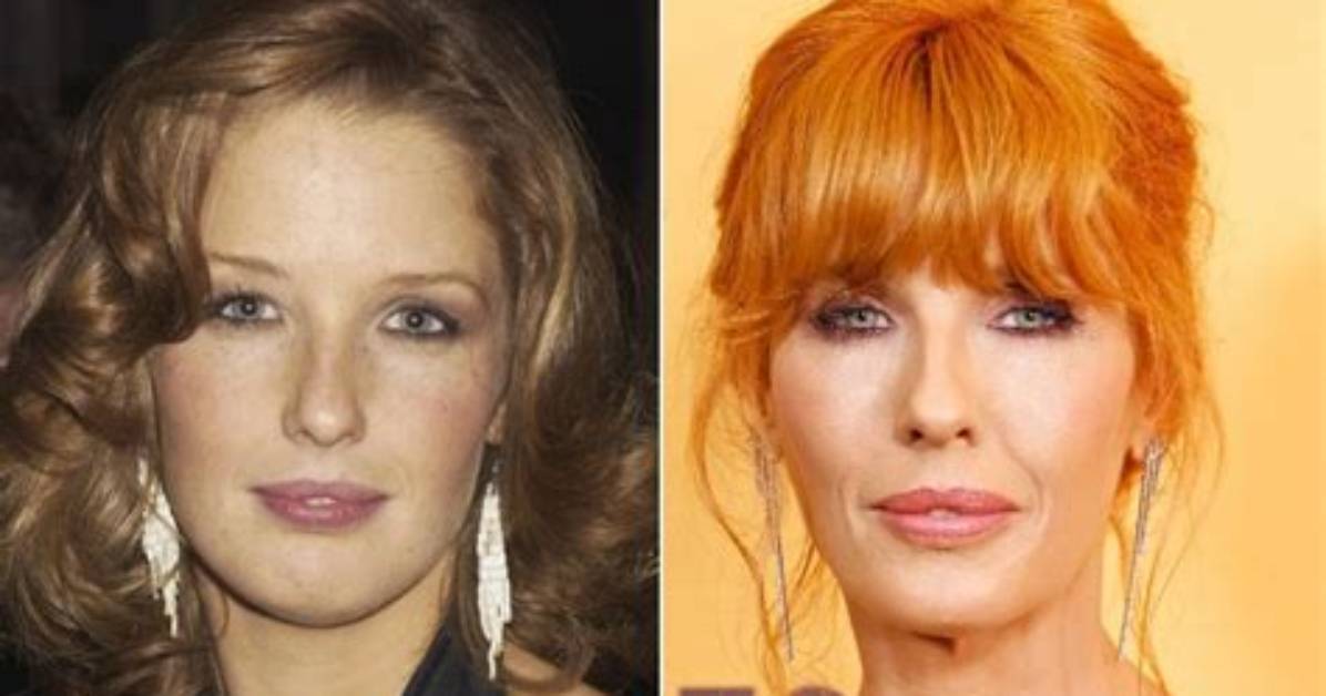 Beth Dutton Lip Injections: Surgery Before and After Photos
