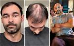 Embracing Baldness: the Journey of Bald Ppl