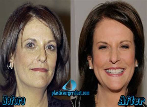 Gloria Borger's Facelift: Before and After Photos and Details