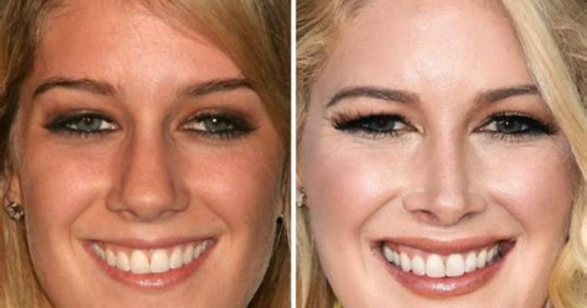 Heidi Transformation: Before and After Photos