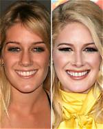 Heidi Transformation: Before and After Photos