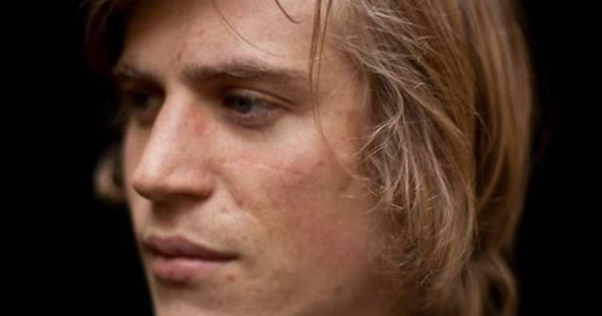 Johnny Flynn's Facial Scars: Origin and Story