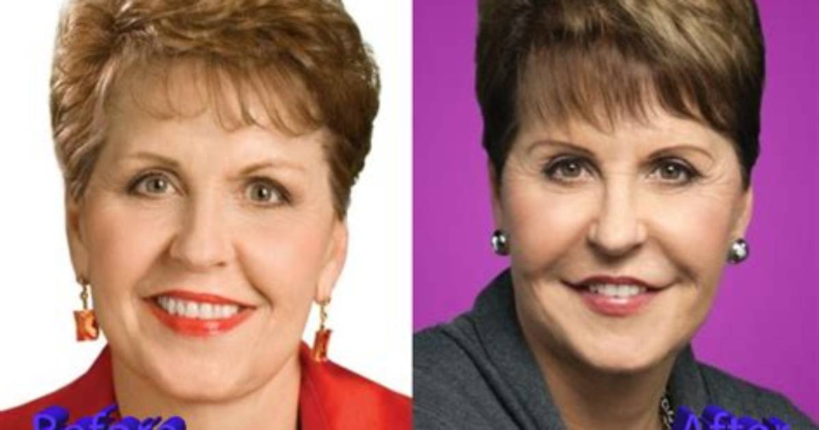 Joyce Meyer Botox: Uncovering the Surprising Truth