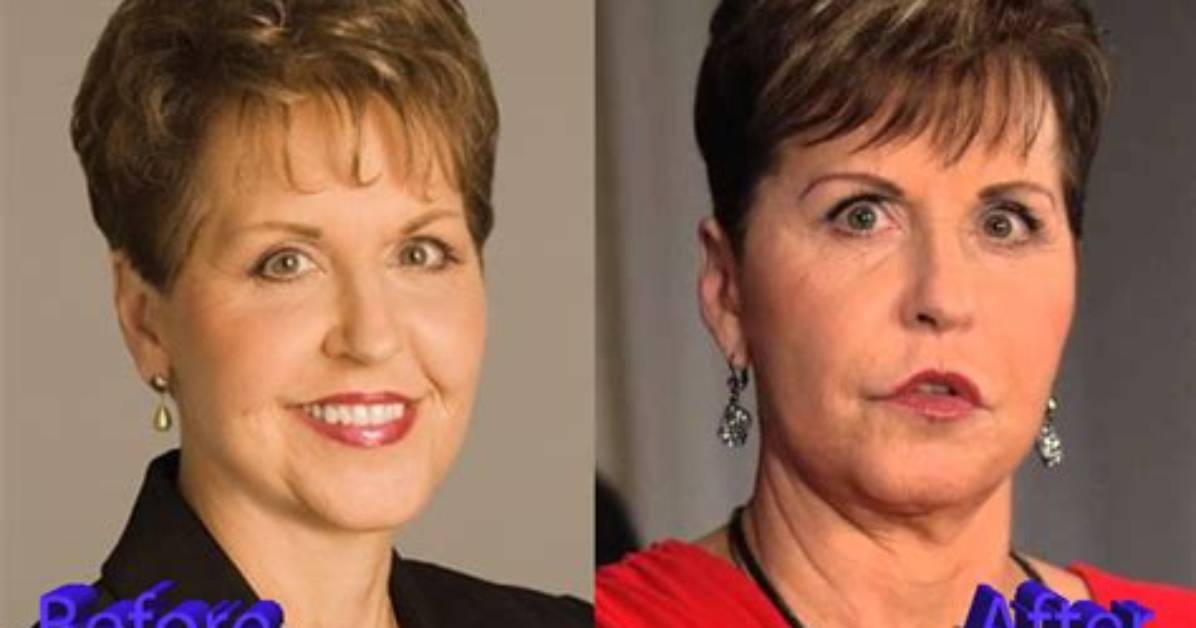 Joyce Meyer Plastic Surgery: Discoveries and Insights Uncovered!