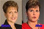 Joyce Meyer Plastic Surgery: Discoveries and Insights Uncovered!