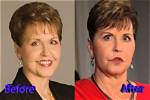 Joyce Meyer's Facelift: Uncovering the Truth