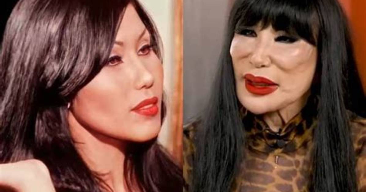 Lyn May: the Transformation Through Plastic Surgery