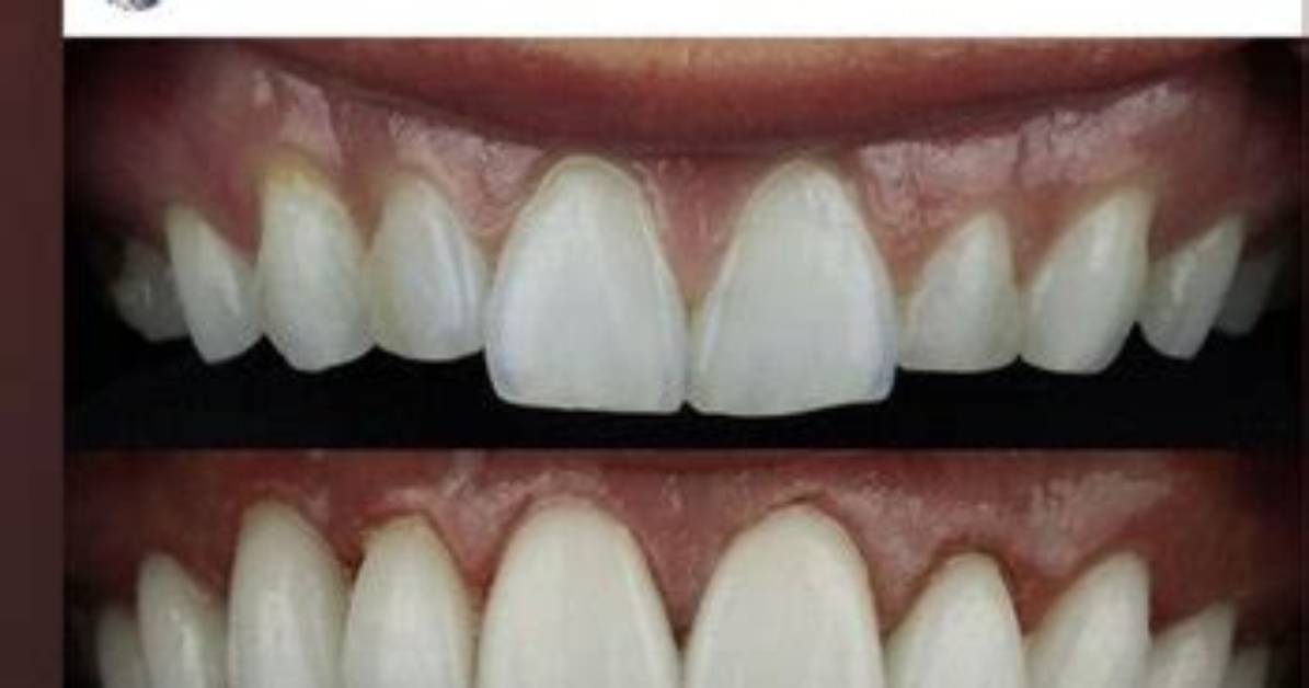 Madison Lecroy Teeth Before: Has She Used Braces and Whitening