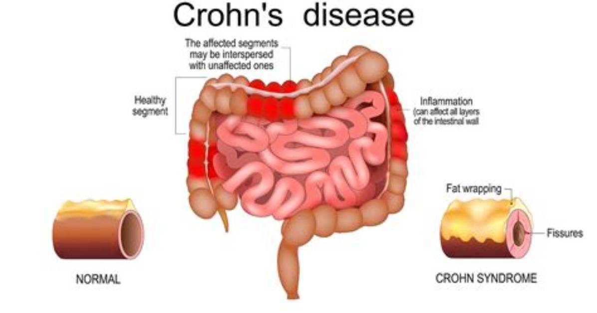 Mrbeast's Battle with Crohn's Disease Unveiled