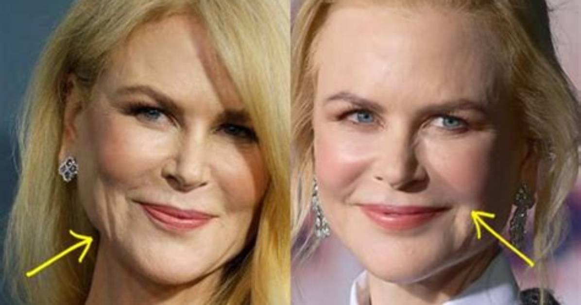 Nicole Kidman's Botox Saga: the Truth Unmasked
