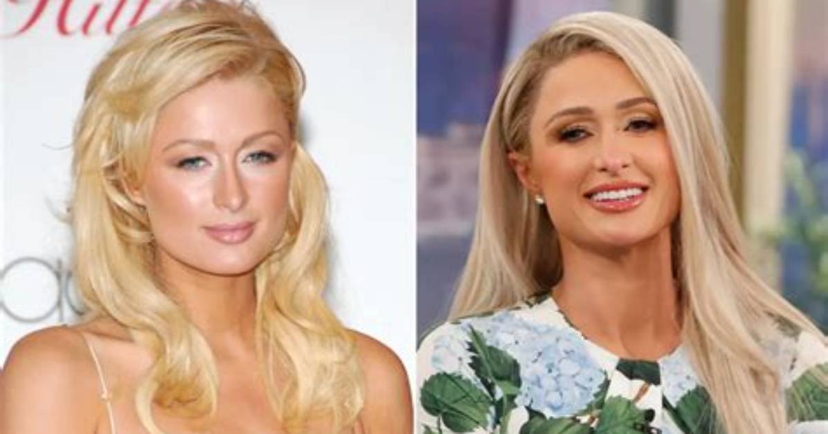 Paris Hilton's Cosmetic Enhancements: a Detailed Guide to Her Fillers