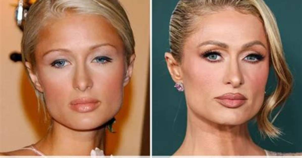 Paris Hiltons Transformation: Before and After Rhinoplasty