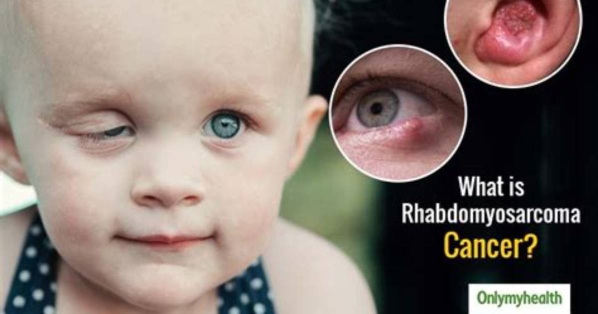 Ryan Peniston and Rhabdomyosarcoma Eye Cancer Update, What Happened?