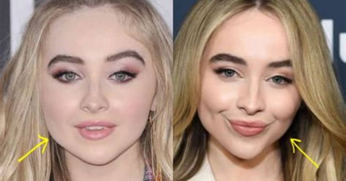 Sabrina Carpenter's Botox Transformation: Before and After