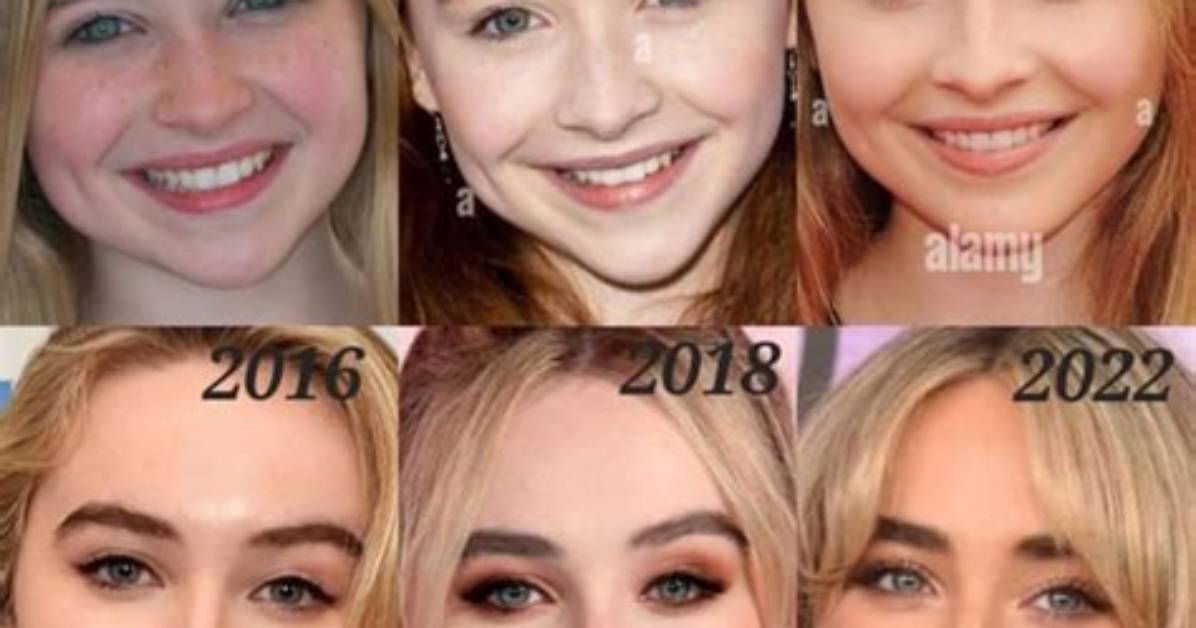 Sabrina Carpenter's Lip Filler: Exploring the Transformation