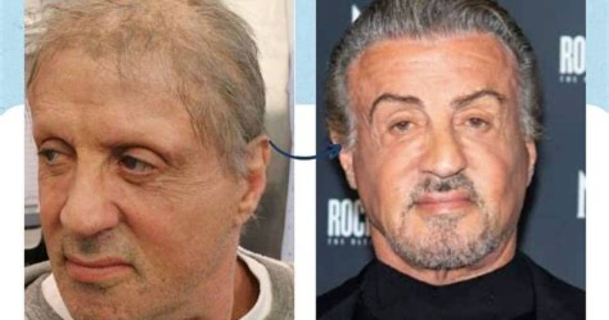 Sylvester Stallone's Hair Restoration Journey
