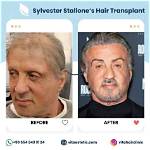 Sylvester Stallone's Hair Restoration Journey