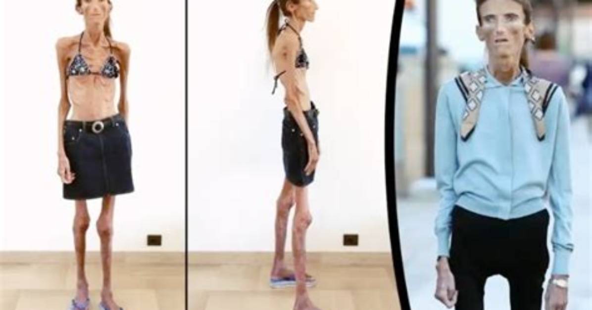 The Remarkable Journey of the Thinnest Person in the World