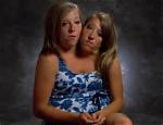 The Tragic Cause Behind the Hensel Twins' Untimely Death