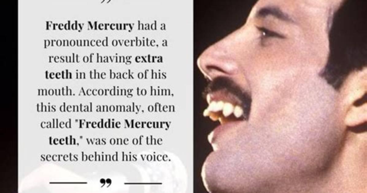Truth About Freddie Mercury’s Teeth That Gave Him His Unique Smile