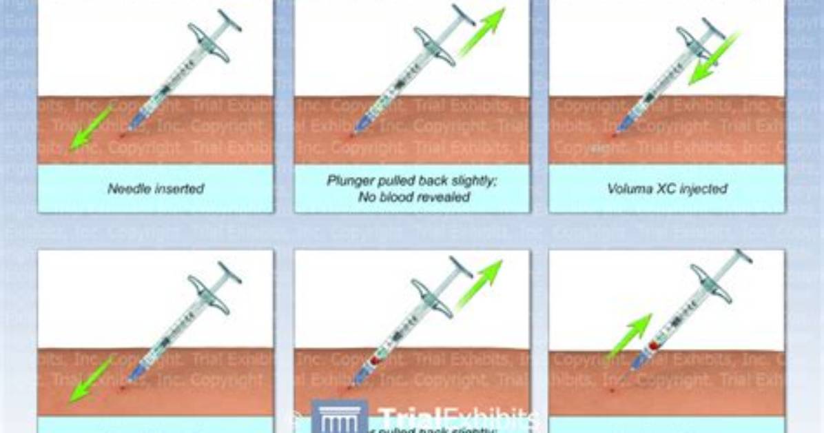 Ultimate Guide to Aspirate Needle Injection: Techniques and Applications
