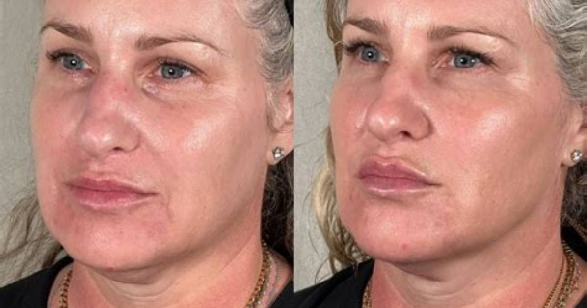 Uncovering the Truths Behind Joyce Meyer's Plastic Surgery Journey