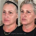 Uncovering the Truths Behind Joyce Meyer's Plastic Surgery Journey