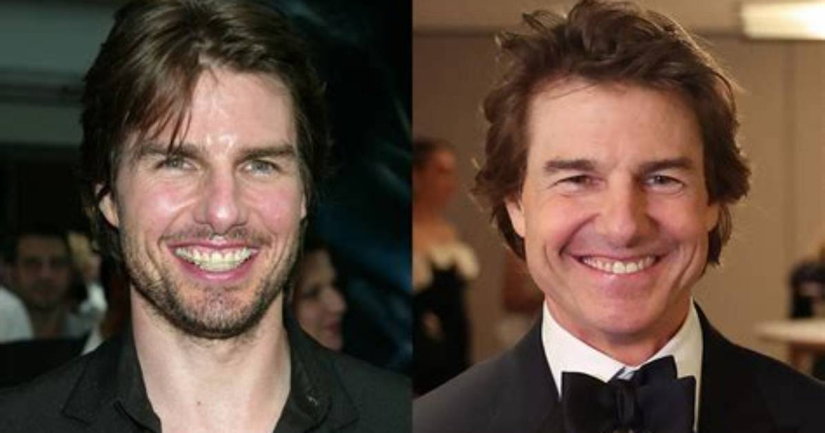 Unique Smiles: Exploring Actors with Underbites