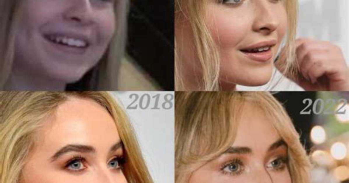 Unveiling the Transformation: Sabrina Carpenter Before Lip Filler