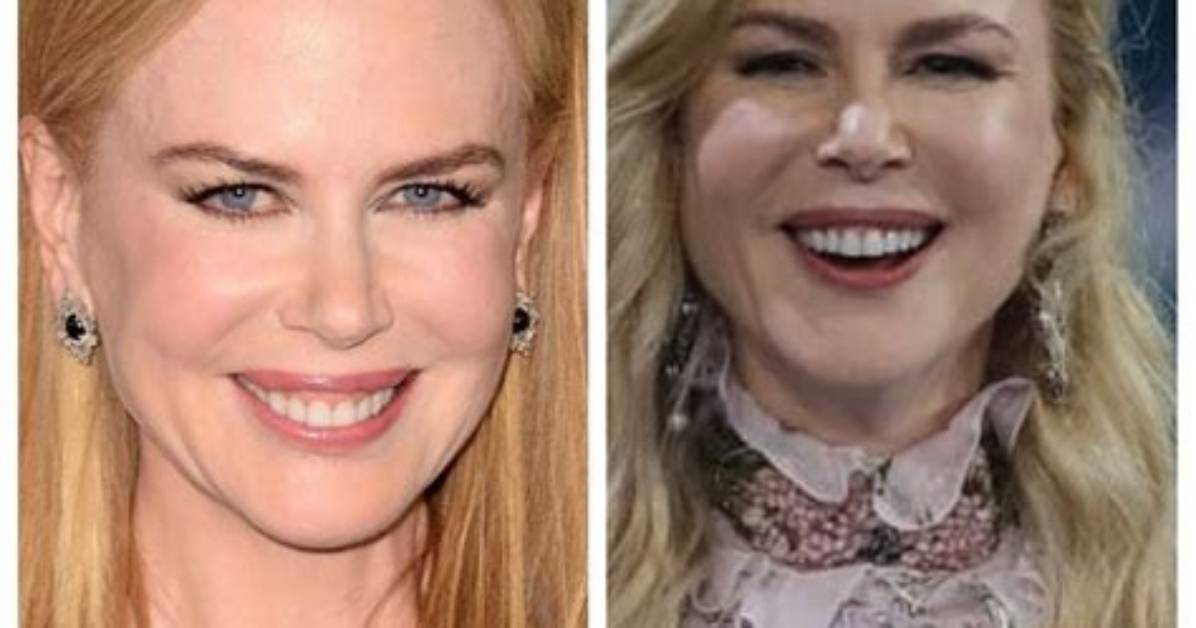 Unveiling the Truth Behind Nicole Kidman's Facelift: a Journey Through Time