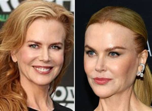 Unveiling the Truth: Does Nicole Kidman Have an Eating Disorder?