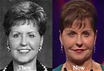 Unveiling the Truth: Joyce Meyer Face Surgery