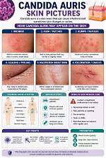 What Does Candida Auris Look Like on the Skin? All About Deadly Fungus Spreading, Prevention, Symptoms and More