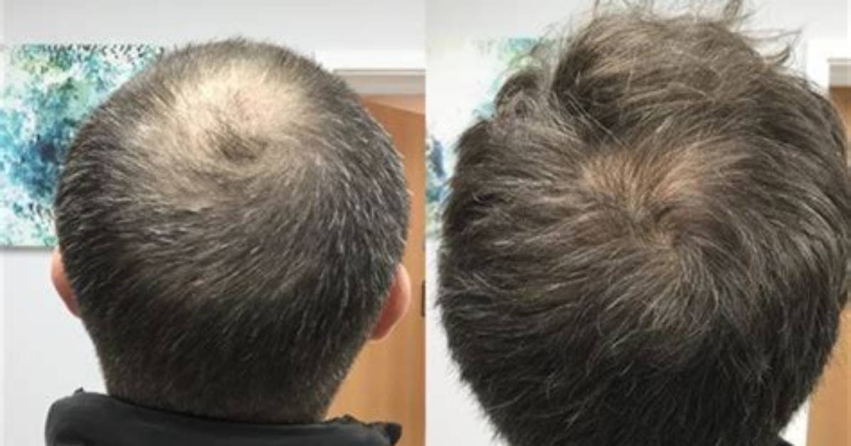 What Happened to Udonis Haslem Head? Bald Spots Leads Fans to Believe He Might Have Alopecia
